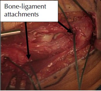 bone ligament attachments