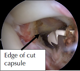Edge of Cut Capsule