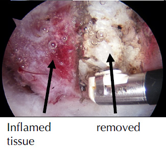 Inflamed Removed Tissue