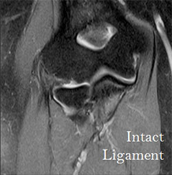 intact ligament