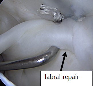 Labral Repair