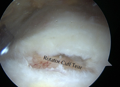 Rotator cuff tears