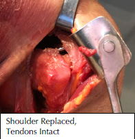 total shoulder replacement without cutting muscles