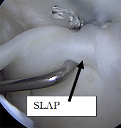 SLAP repair