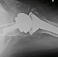 Reverse Total Shoulder Replacement